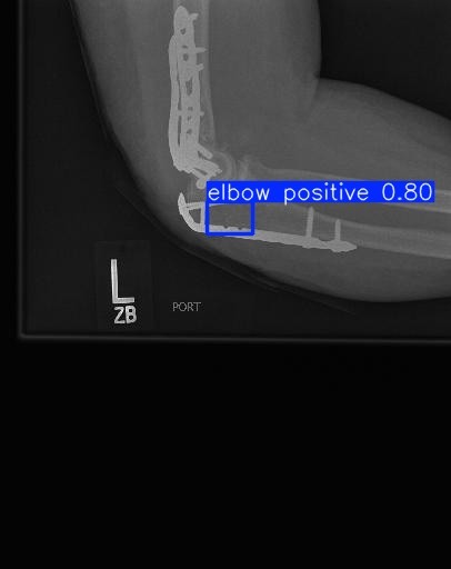 Elbow X-ray with a highlighted region around the joint